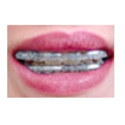 Morgan Bumper Braces Cover Lip Protector ,Clear, 5'